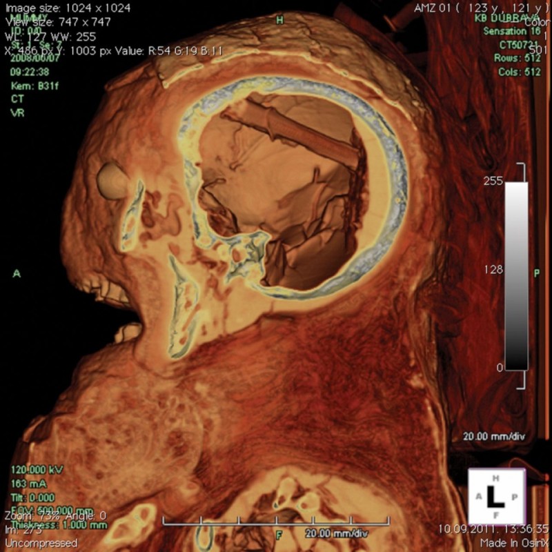 CT-scan-brain-removal-tool- (960 x 960).jpg